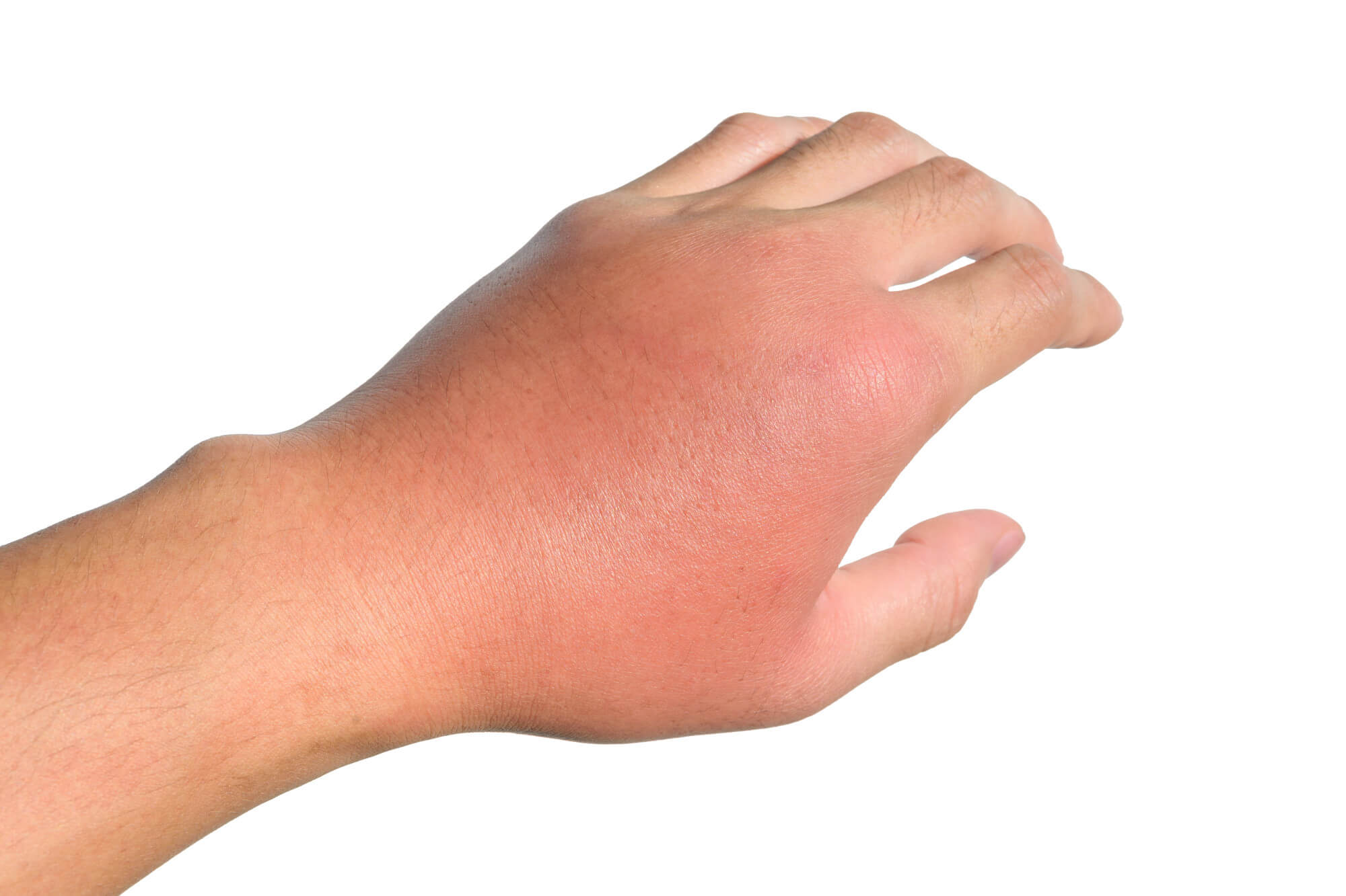 Bee sting allergy symptoms