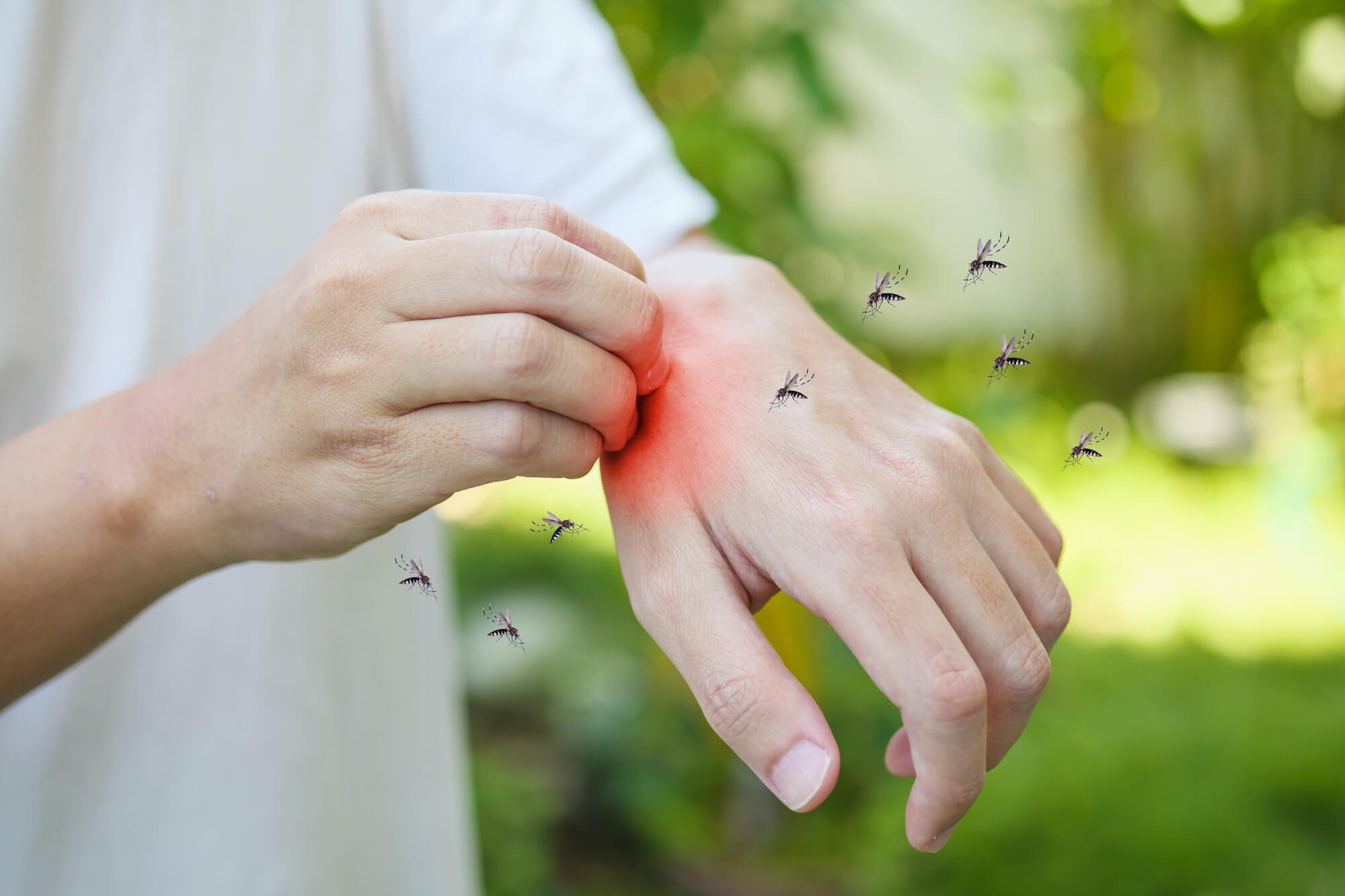 mosquito allergy symptoms