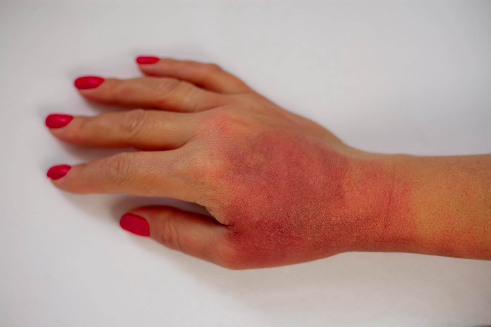 symptoms of henna allergy