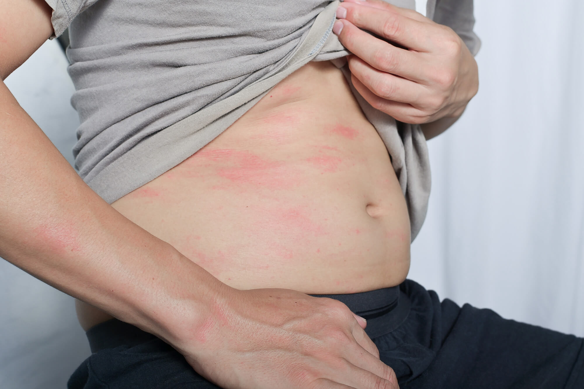 abdominal allergy symptoms