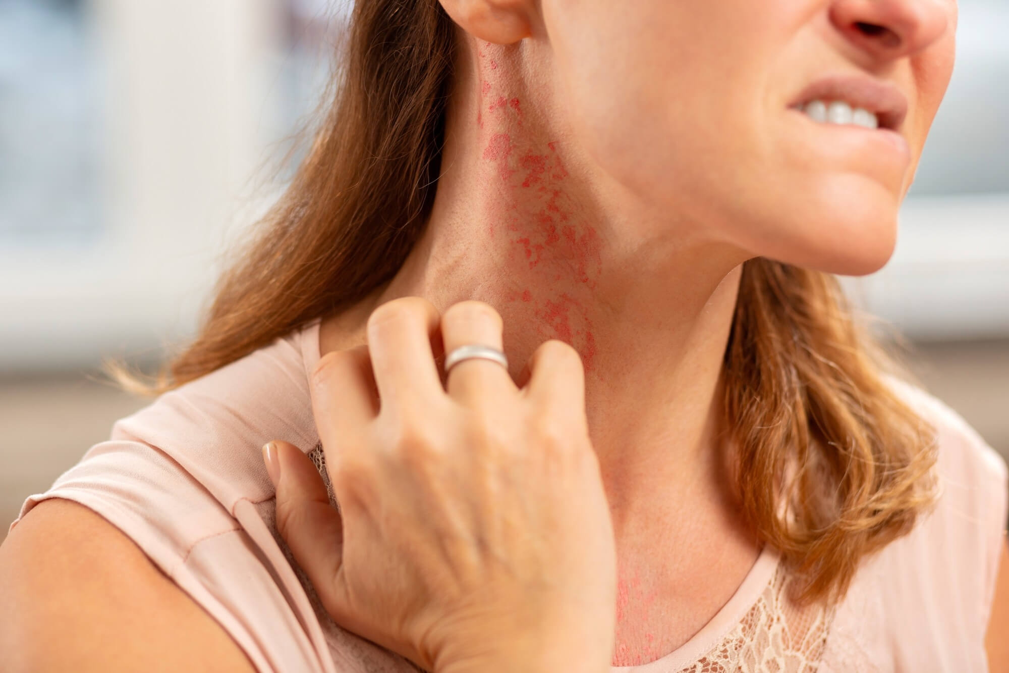 neck allergy symptoms