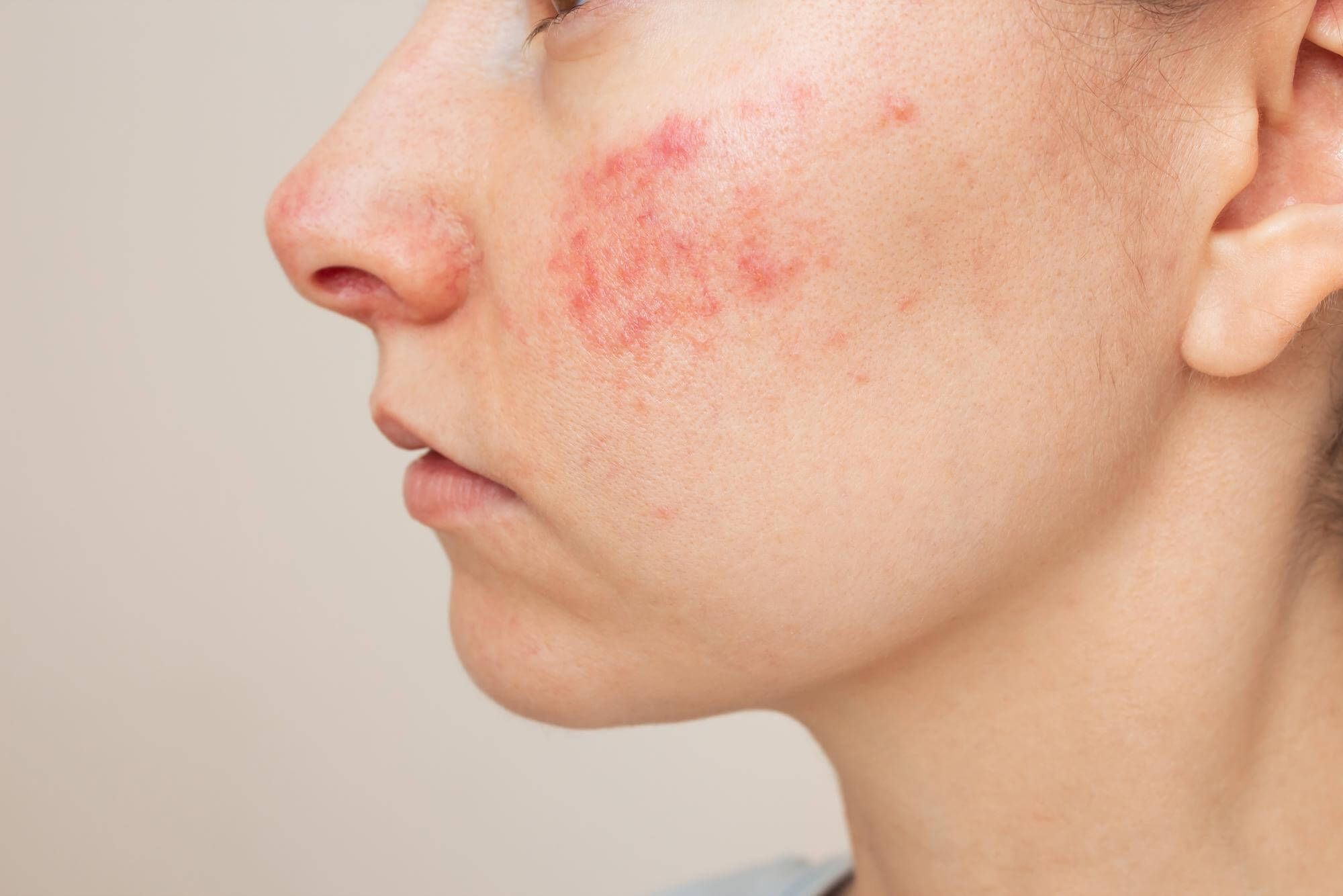 skin manifestations of cheek allergy