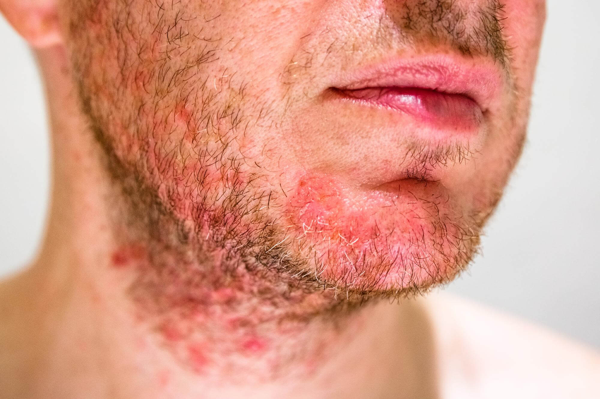 skin manifestations of chin allergy