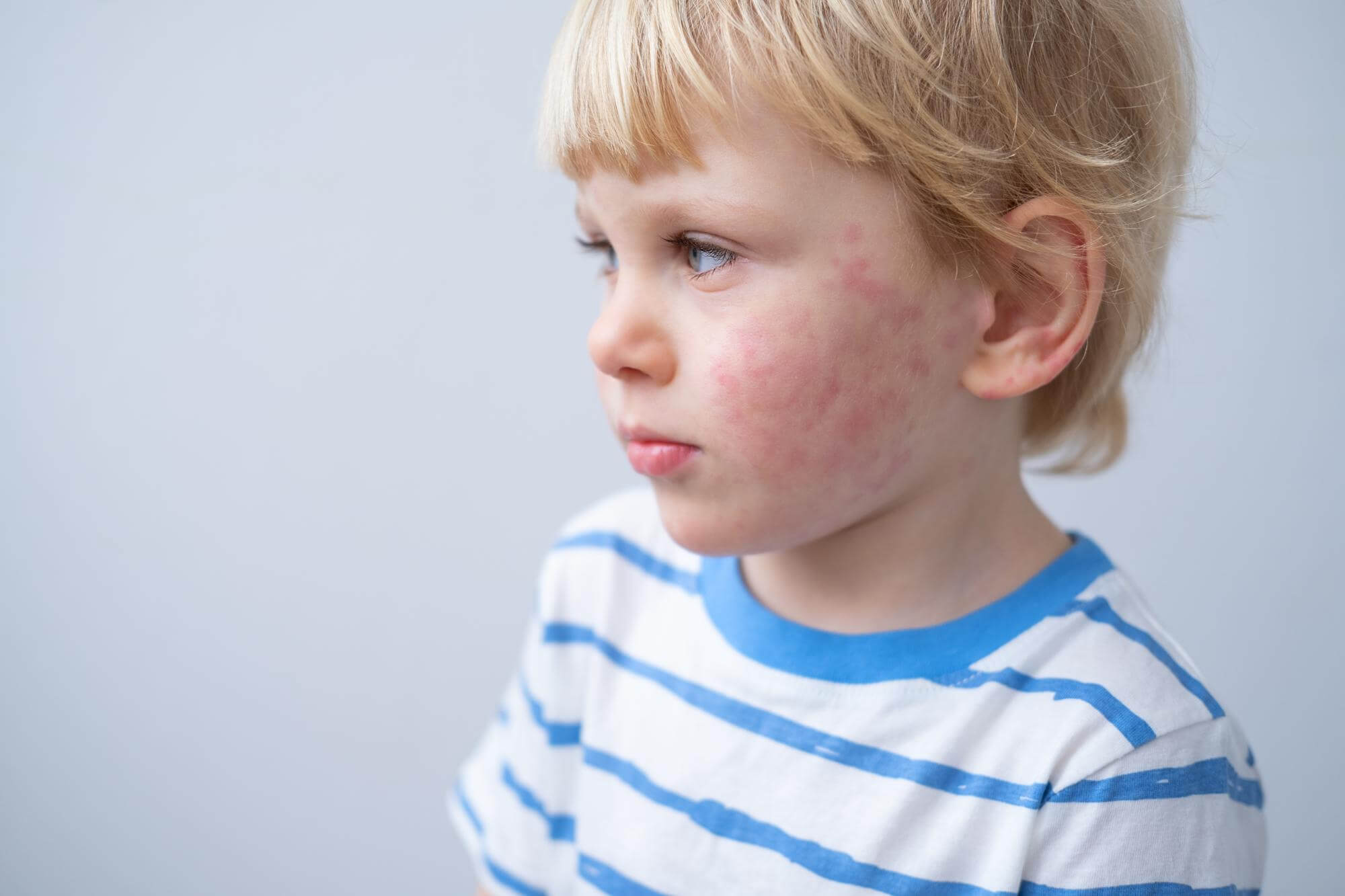 symptoms of atopic dermatitis in children