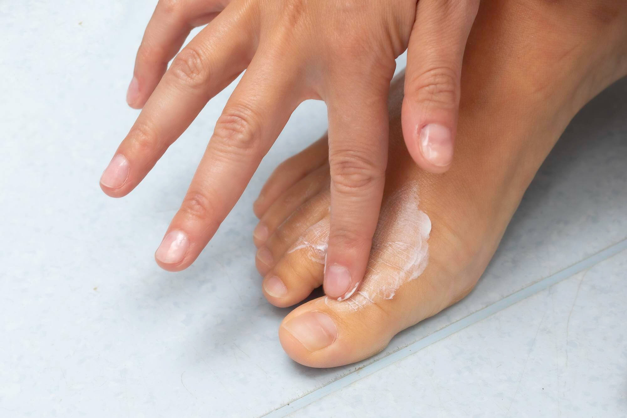 foot eczema treatment