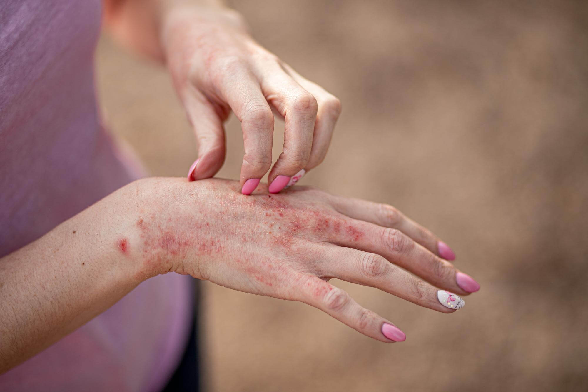 microbial eczema symptoms