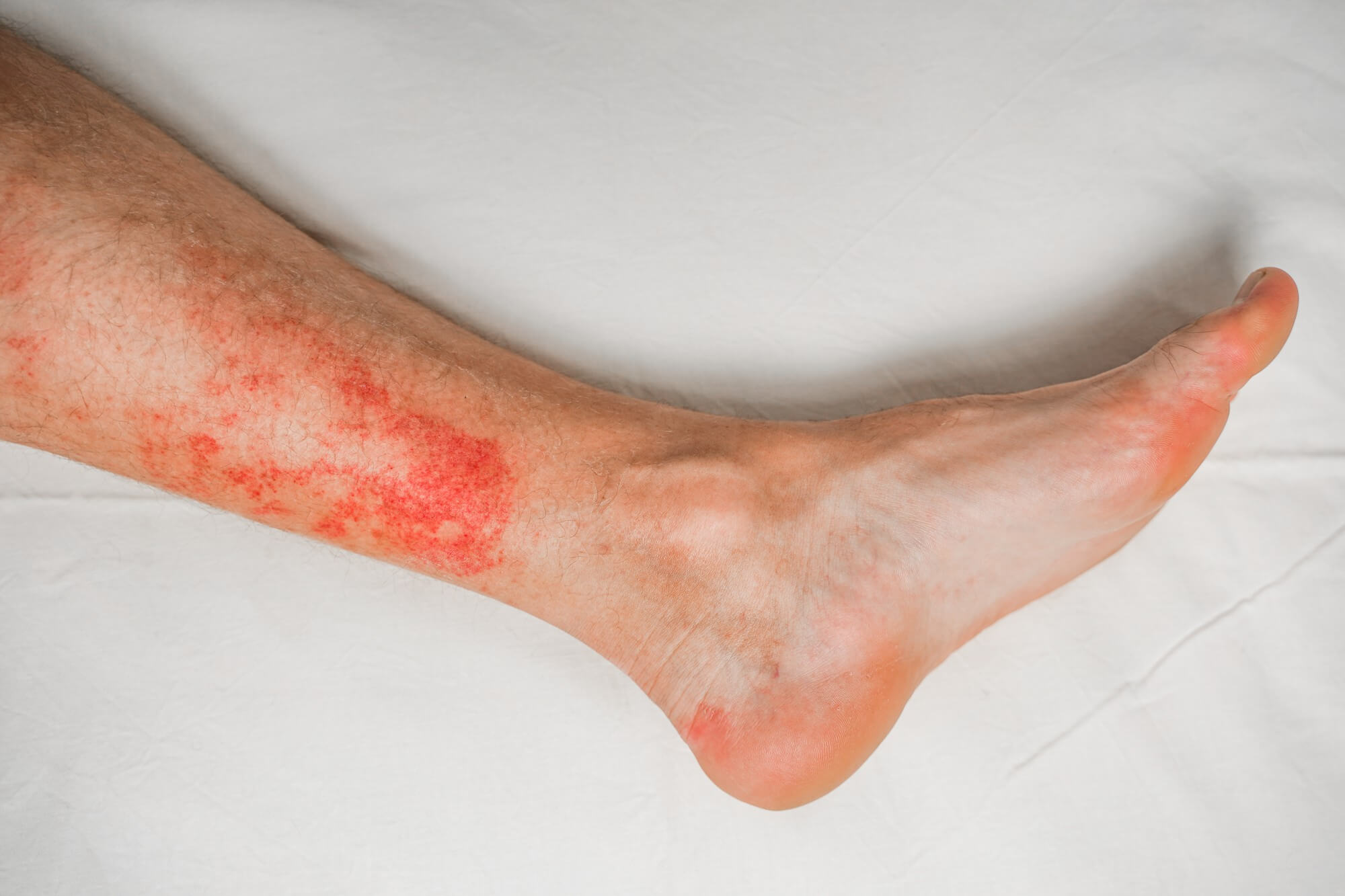 symptoms of wet eczema