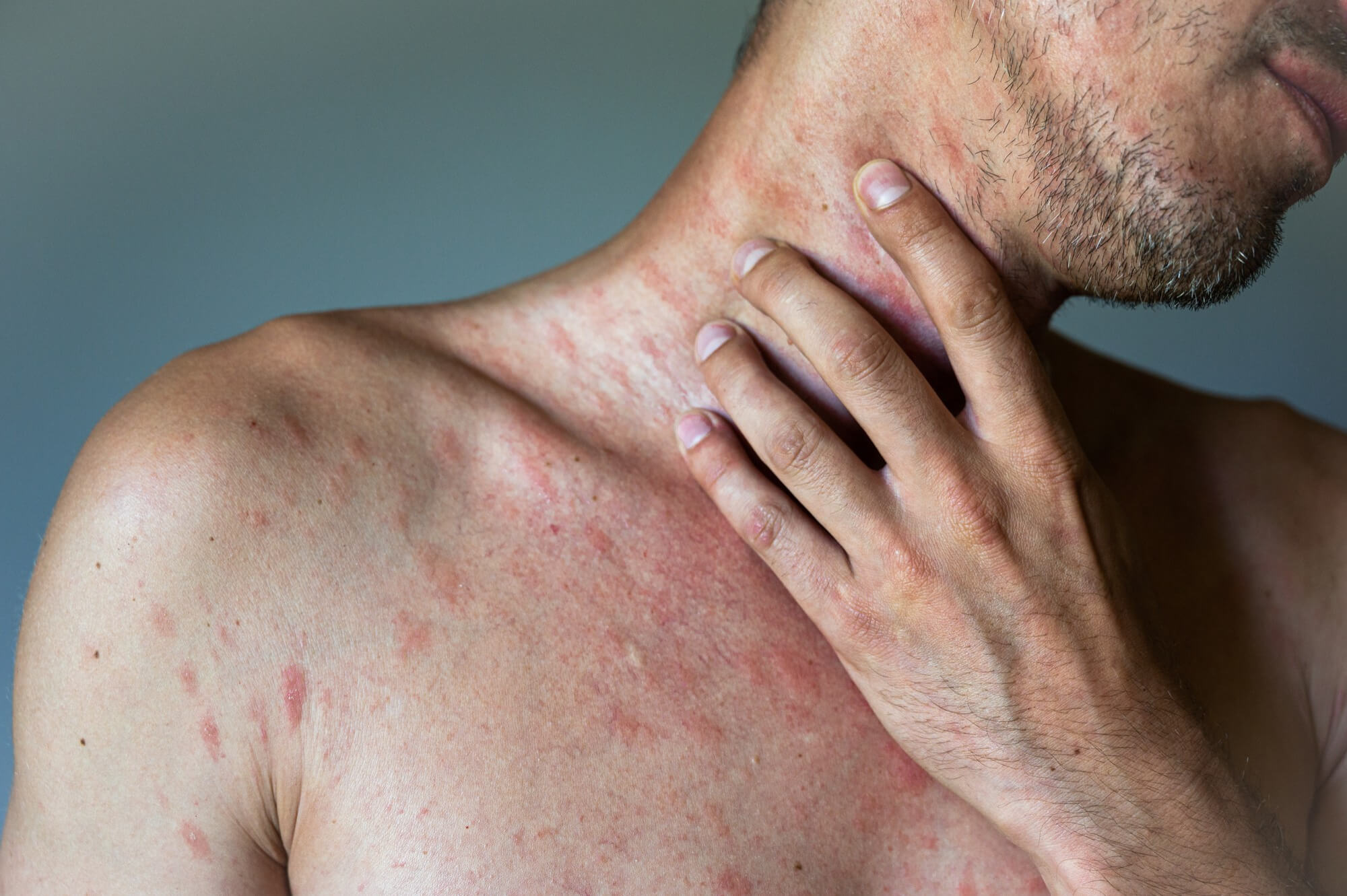 Symptoms of urticaria