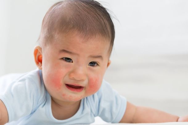 atopic dermatitis in a child