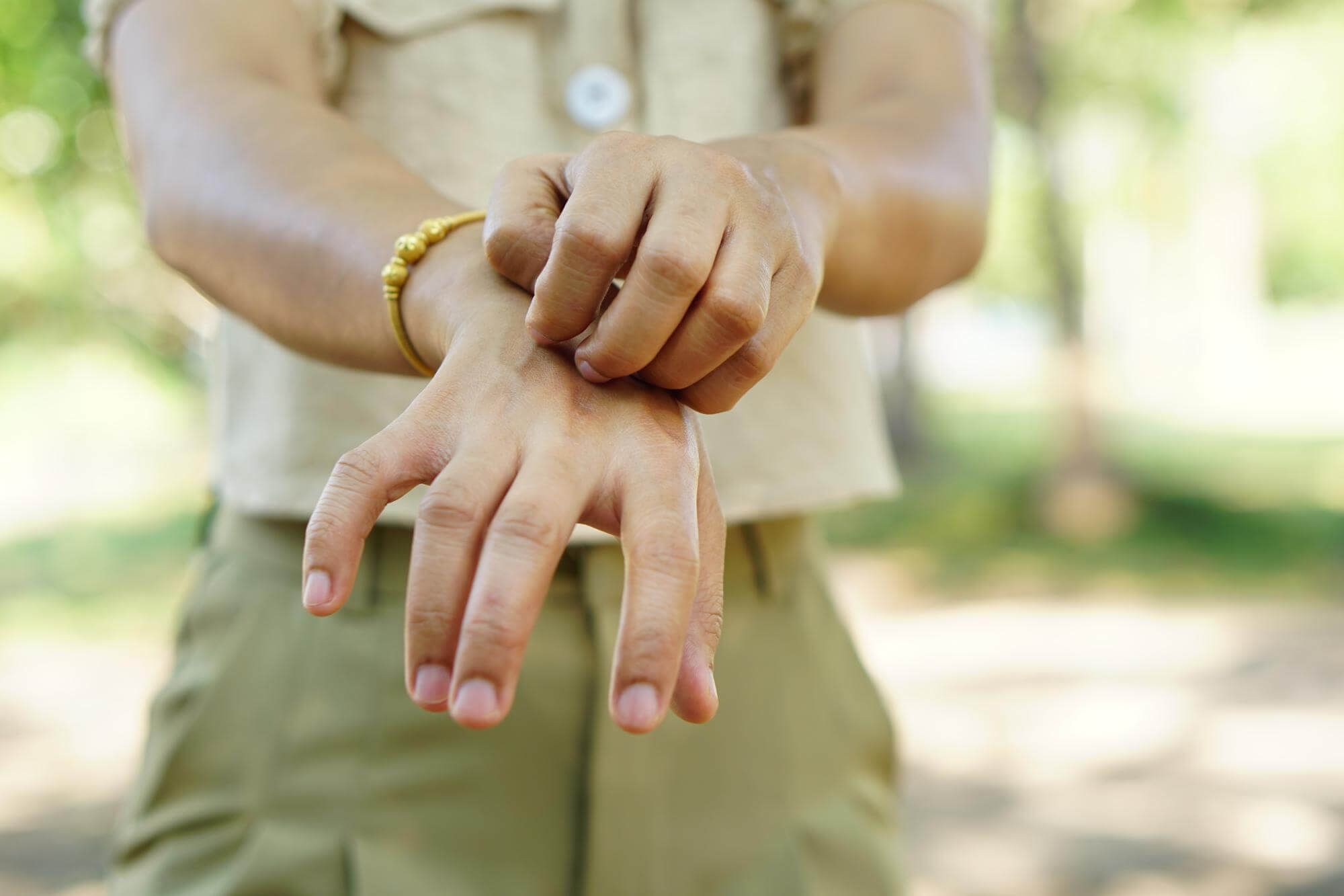 hand eczema