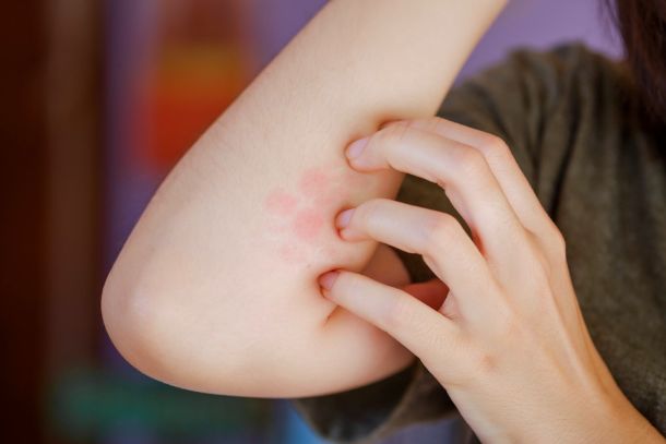 coin-shaped eczema