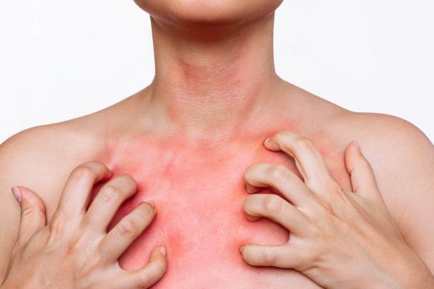 toxic-allergic dermatitis