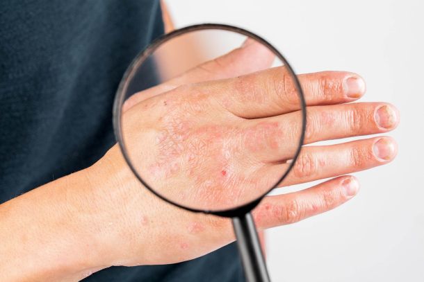 dry eczema