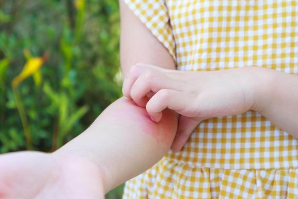 urticaria in children